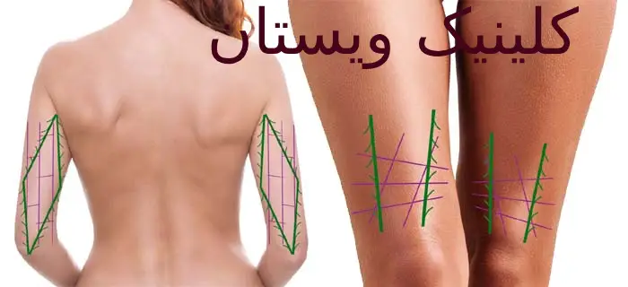 در کلینیک ویستان، تمام پروسه درمان تحت نظارت دقیق پزشکان متخصص و با استفاده از بهترین متدهای روز دنیا انجام میشود. بیمههای مختلفی خدمات لاغری را پوشش میدهند