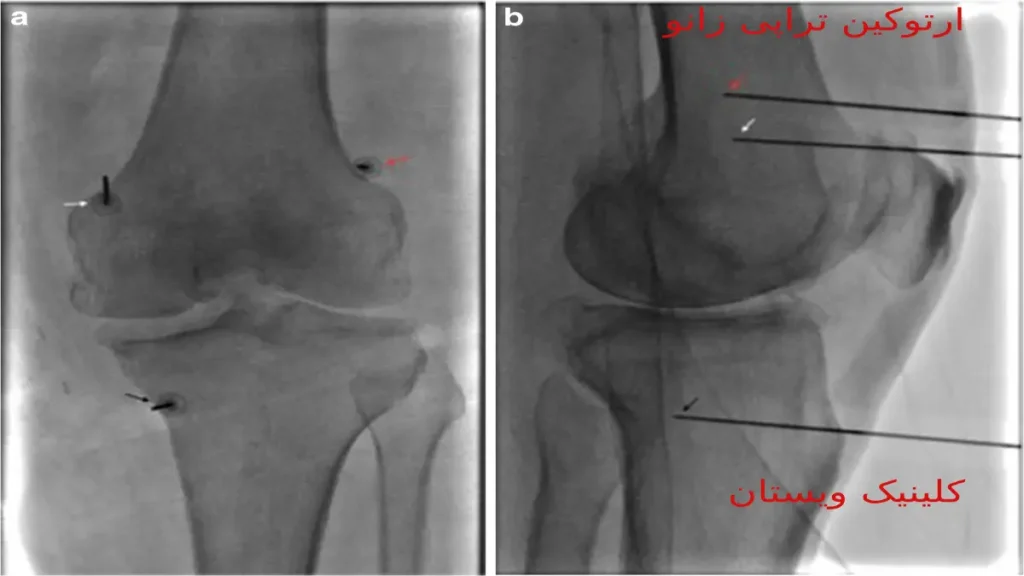 این روش درمانی بهبود کیفیت زندگی بیماران مبتلا به زانو درد را هدف قرار میدهد. ارتوکین تراپی زانو چیست؟