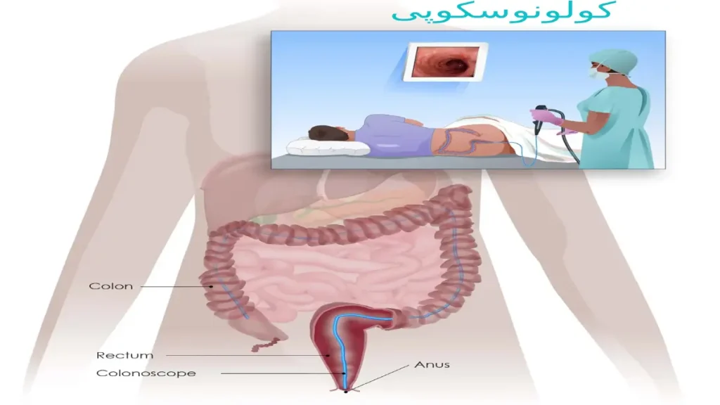 دلایل زیادی برای انجام کولونوسکوپی وجود دارد. آزمایش کولونوسکوپی برای تشخیص چه بیماری هایی است