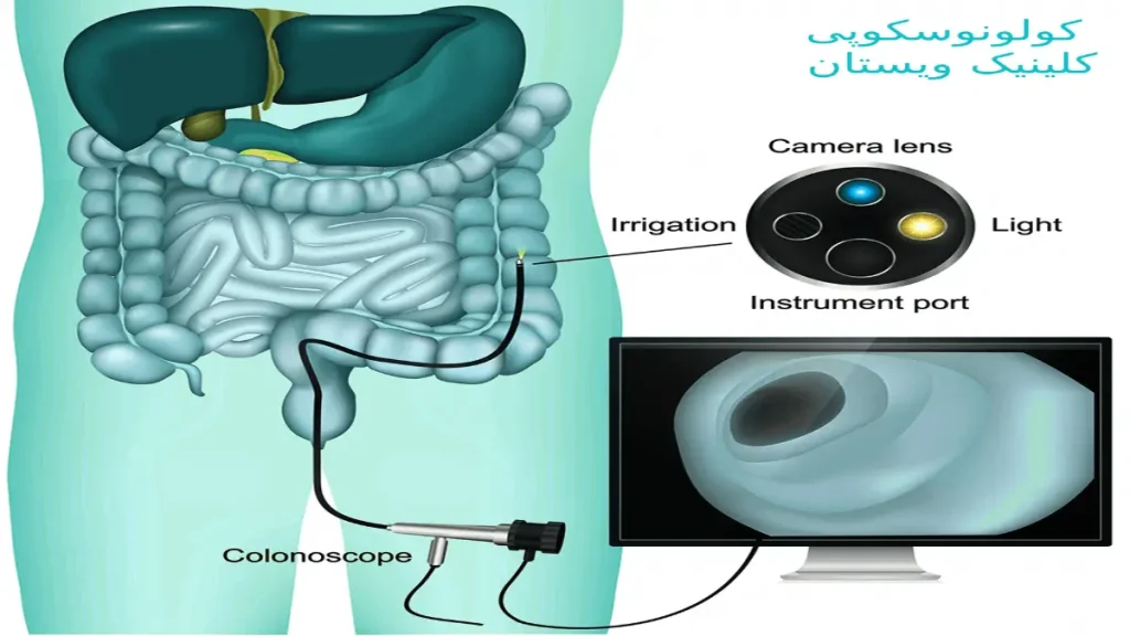 اگر از درد شکم رنج می برید، پزشک ممکن است کولونوسکوپی را برای بررسی علل احتمالی مانند مشکلات روده، اسهال مزمن و خونریزی مقعدی انجام دهد. آزمایش کولونوسکوپی برای تشخیص چه بیماری است