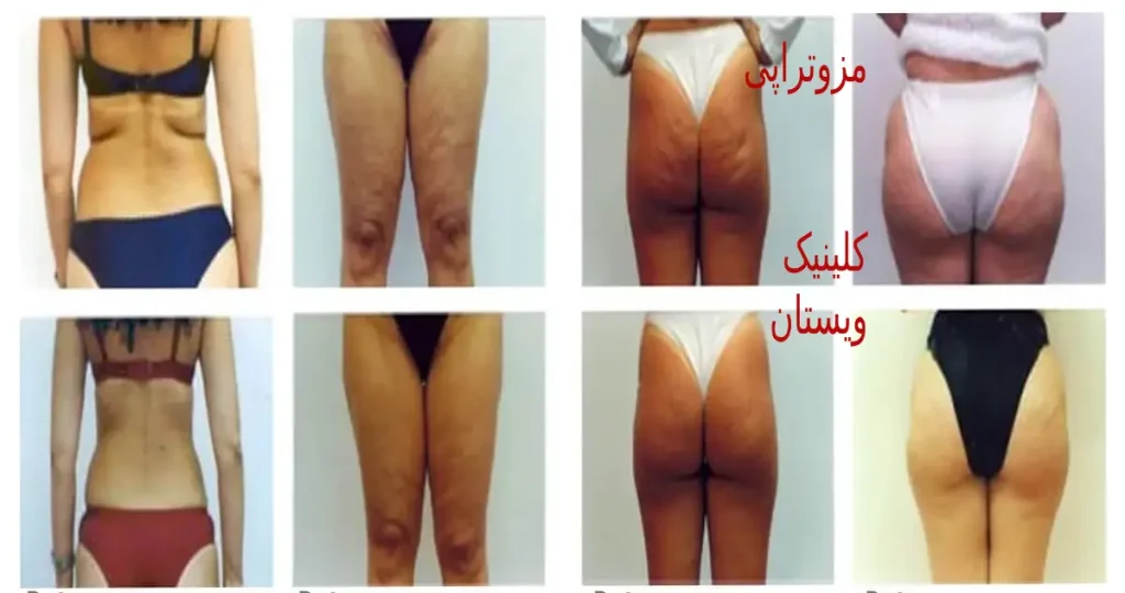 در کلینیک ویستان، لاغری موضعی با روشهای پیشرفته مزوتراپی ارائه میشود. مزوتراپی در کلینیک ویستان، پاسخی برای چربیهای سرسخت شماست.