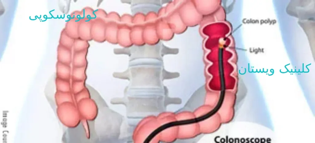 قبل از کولونوسکوپی، IV شروع می شود و بیمار به طور مداوم تحت نظر خواهد بود هزینههای کولونوسکوپی در مراکز درمانی (با و بدون بیمه)