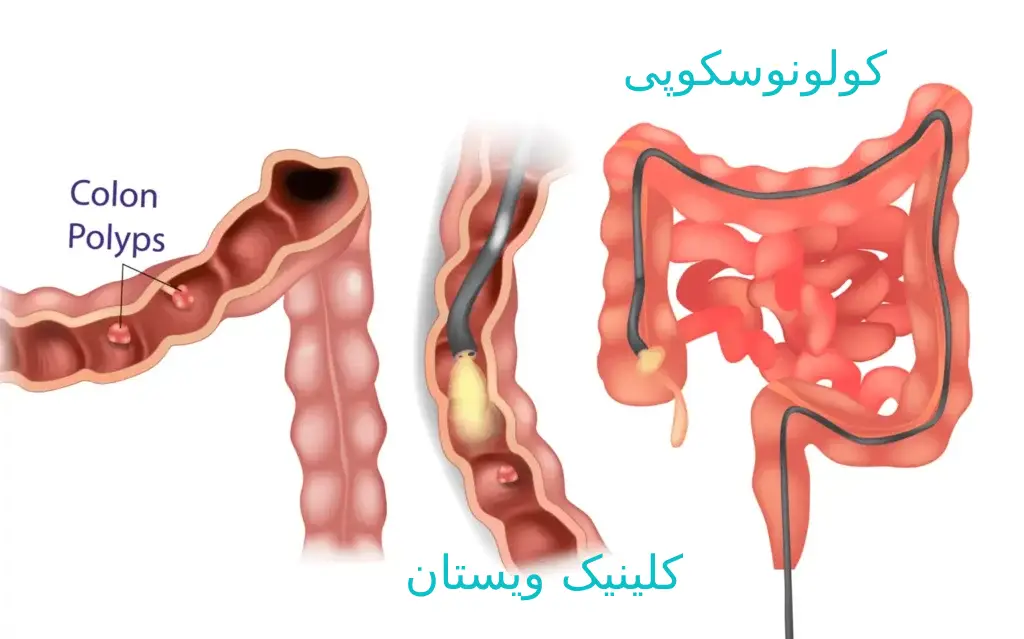 کولونوسکوپی زنانه روشی است که برای بررسی پوشش داخلی روده بزرگ زنان استفاده می شود کولونوسکوپی زنانه روشی است که برای بررسی پوشش داخلی روده بزرگ زنان استفاده می شود.