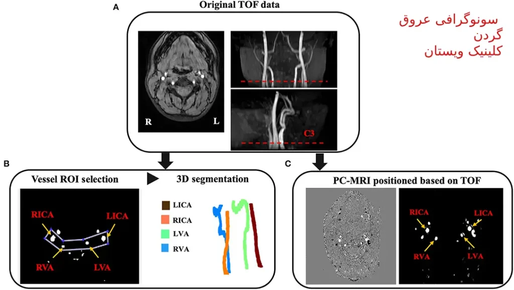 سونوگرافی عروق گردن برای چیست؟