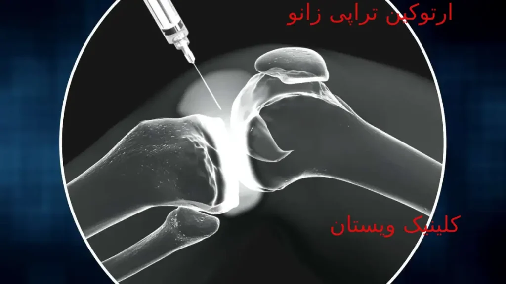 ارتوکین تراپی زانو برای درد مفاصل | مزایا +عوارض