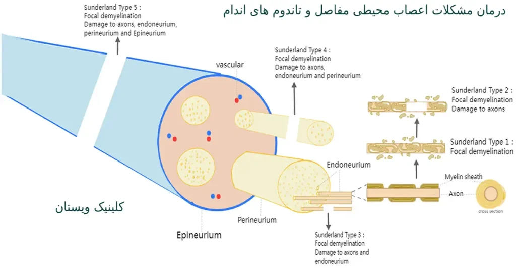 درمان قظعی تاندومیت