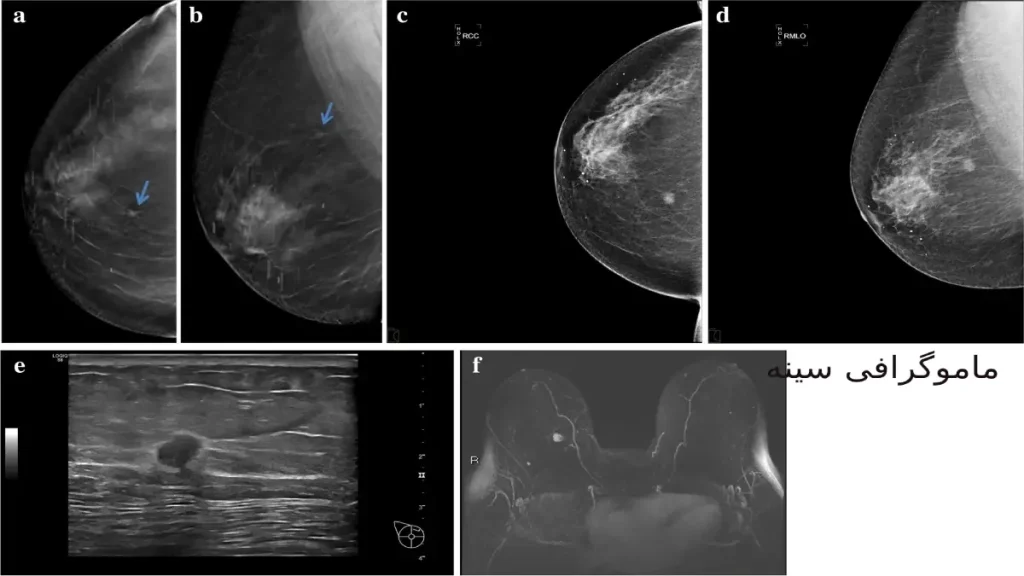 ماموگرافی میتواند تودههای سرطانی را قبل از لمسشدن شناسایی کند هزینه ماموگرافی در کلینیک ویستان