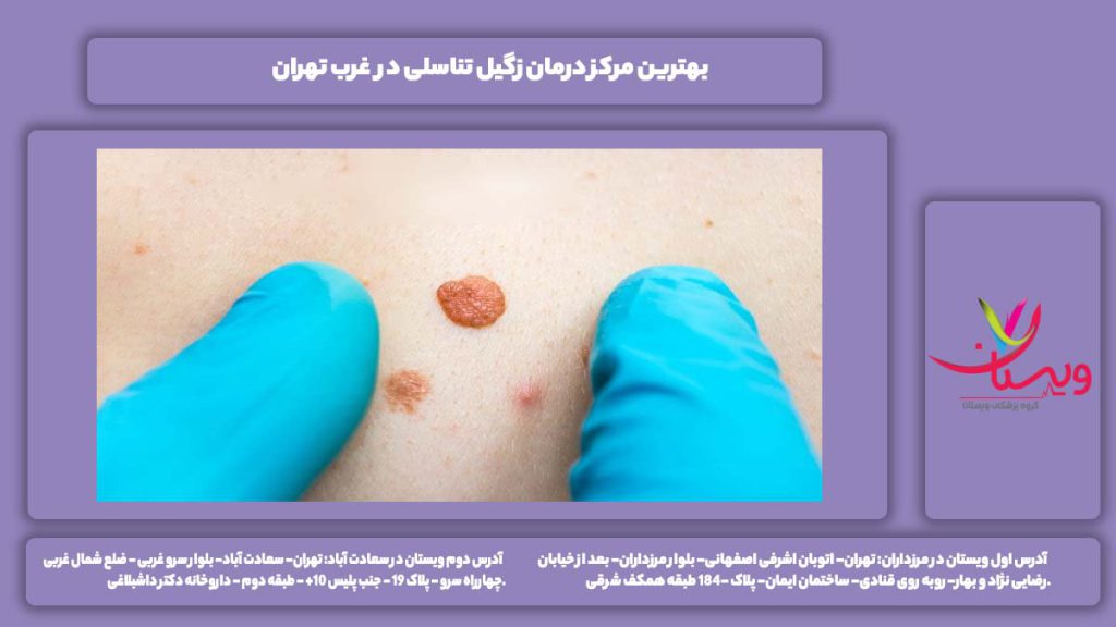 بهترین مرکز درمان زگیل تناسلی