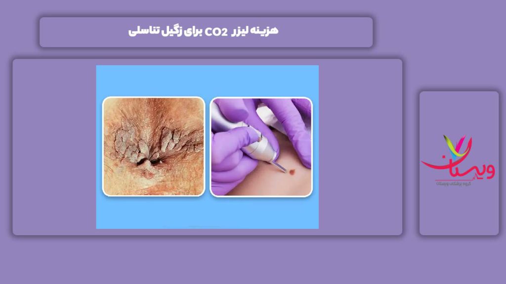 قیمت لیزر co2 برای زگیل تناسلی هزینه لیزر CO2 برای زگیل تناسلی