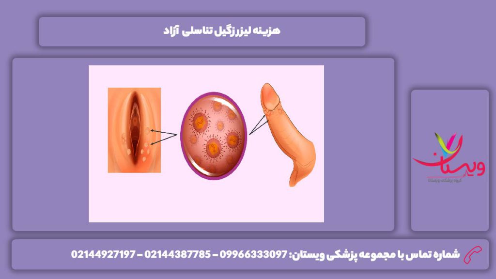 تعرفه آزاد لیزر کردن زگیل در ناحیه تناسلی هزینه لیزر زگیل تناسلی