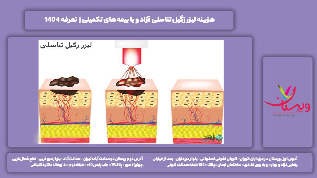 هزینه لیزر زگیل تناسلی