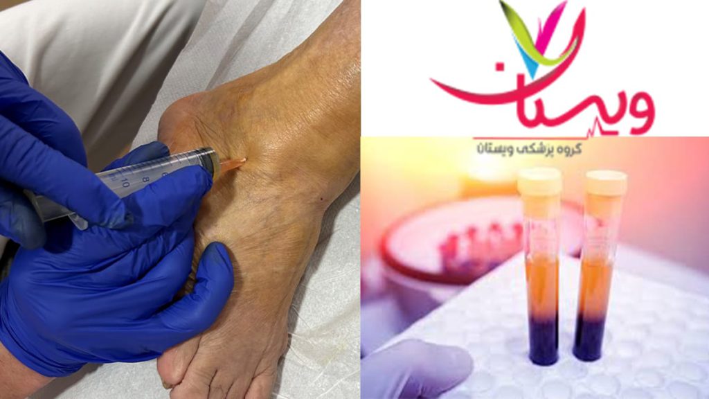 تزریق prp مچ پا در کلینیک ویستان تزریق prp مچ پا در کلینیک ویستان