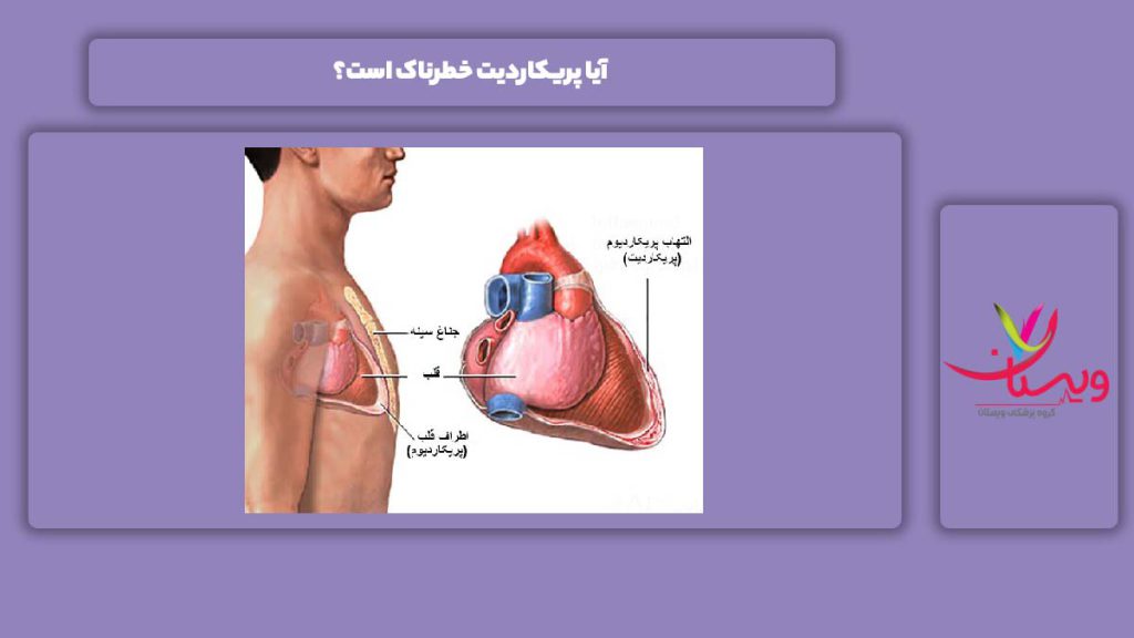 خطرناک بودن بیماری پریکاردیت آیا پریکاردیت خطرناک است؟