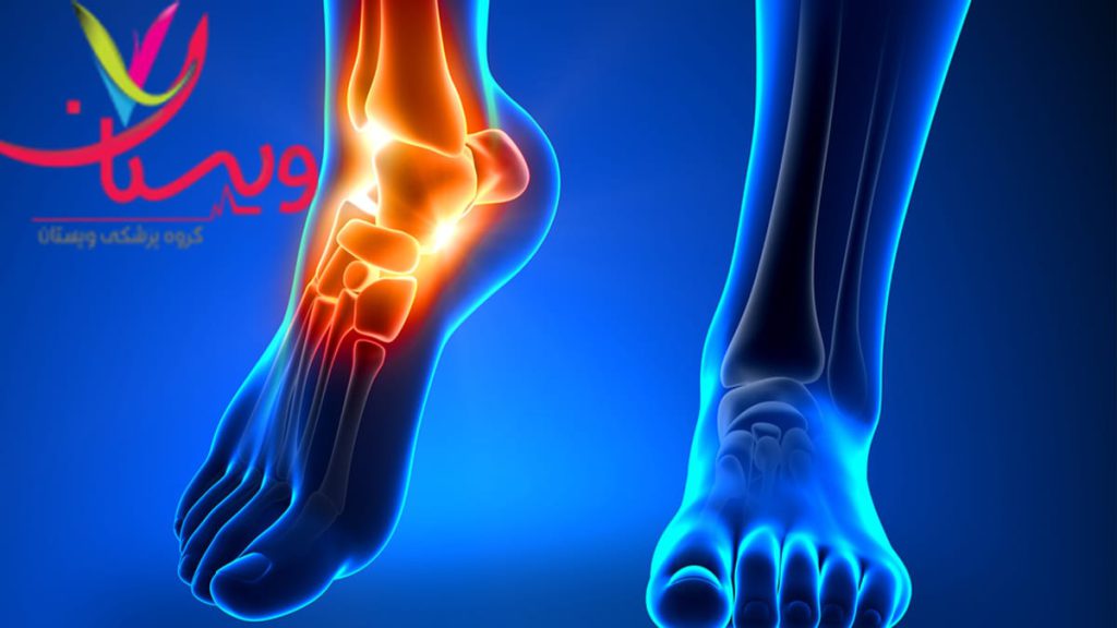 التهاب مچ پا