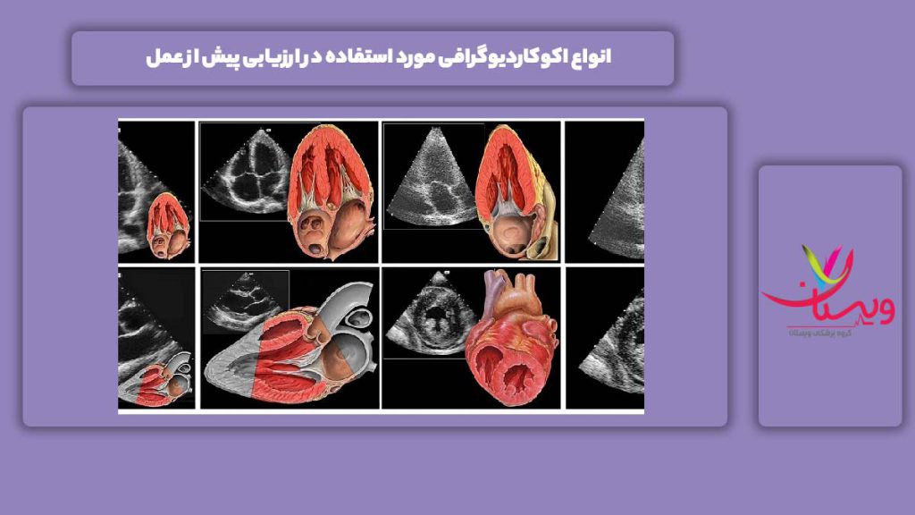 انواع اکوکاردیوگرافی مورد استفاده در ارزیابی پیش از عمل
