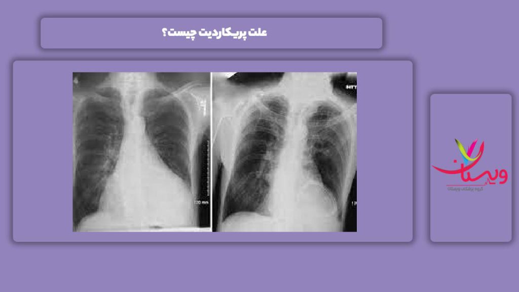 عامل به وجود آمدن پریکاردیت علت پریکاردیت چیست؟