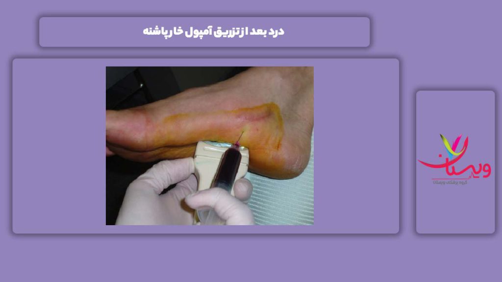 درد بعد از تزریق آمپول خار پاشنه