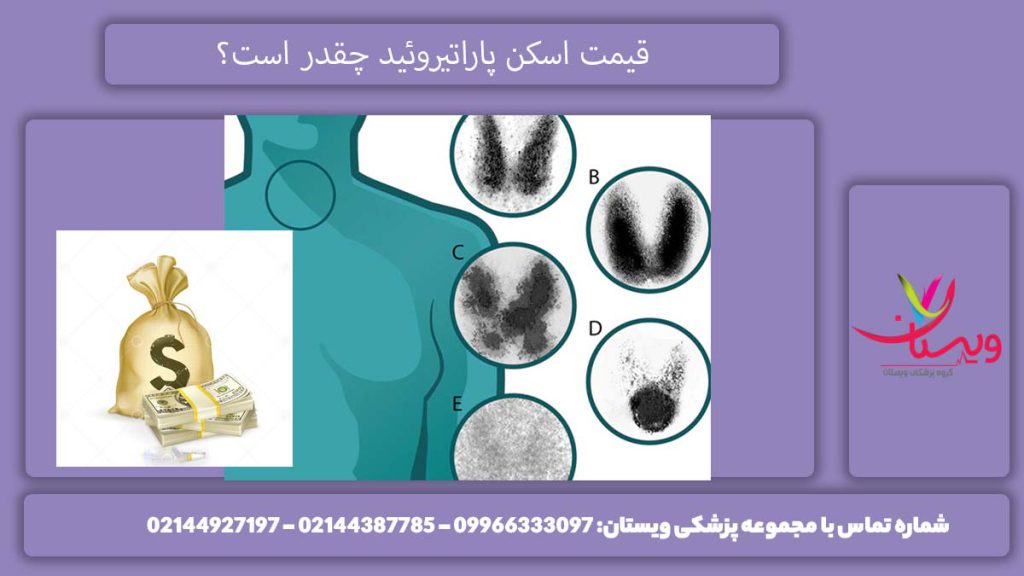 هزینه اسکن پاراتیروئید چقدر است؟