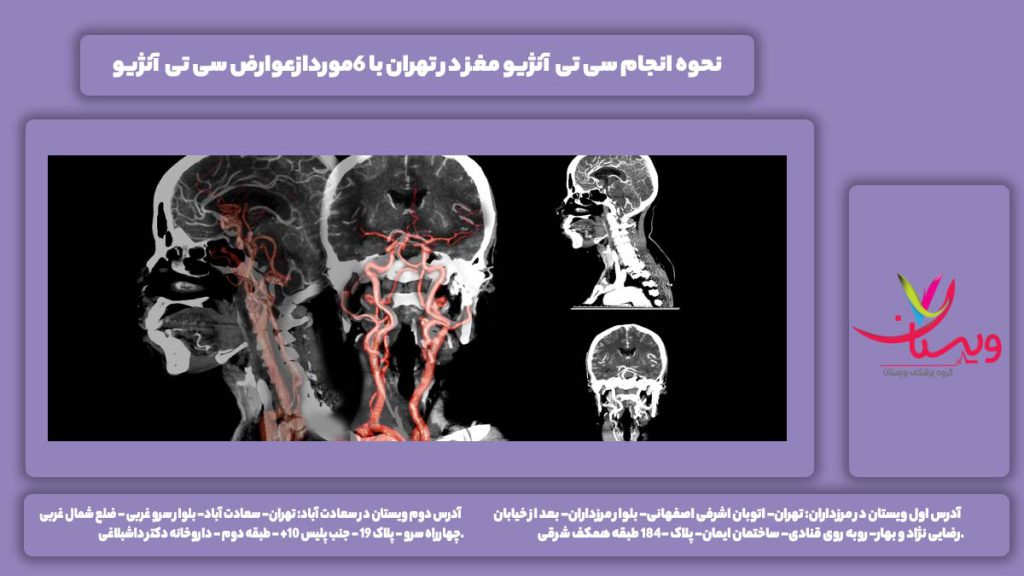 سی تی آنژیو مغز در تهران