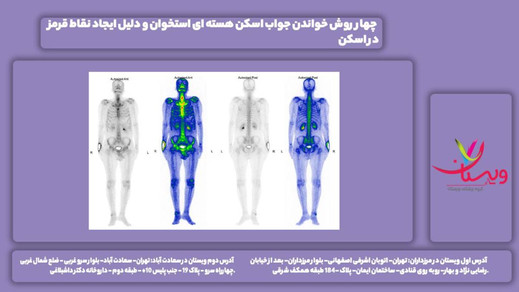 اسکن هسته ای استخوان