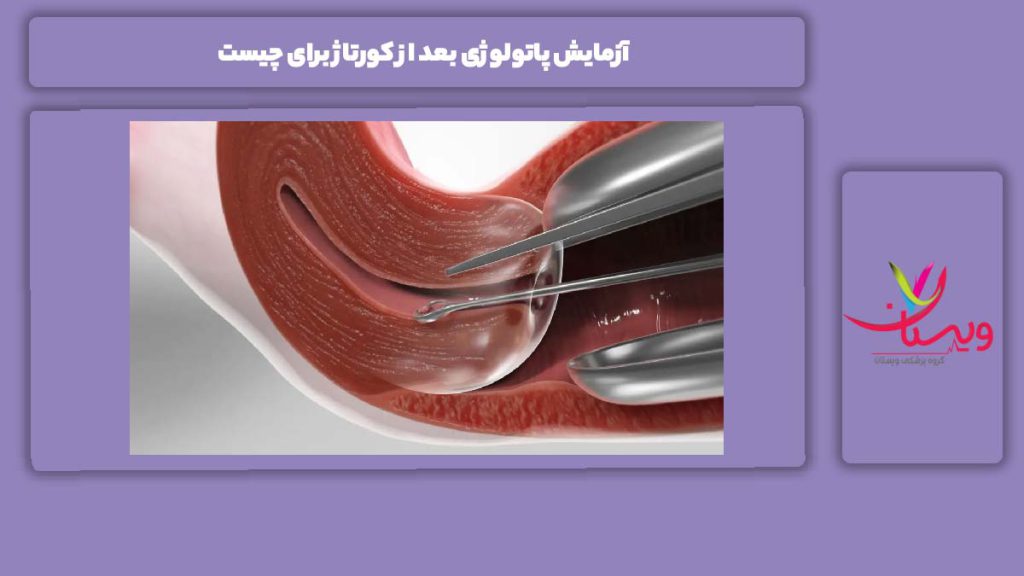 ویژگی این آزمایش بعد از کورتاژ آزمایش پاتولوژی بعد از کورتاژ برای چیست