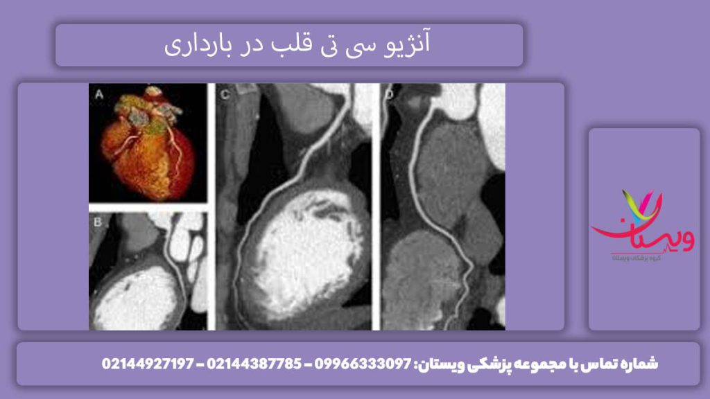 سی تی آنژیو قلب در بارداری