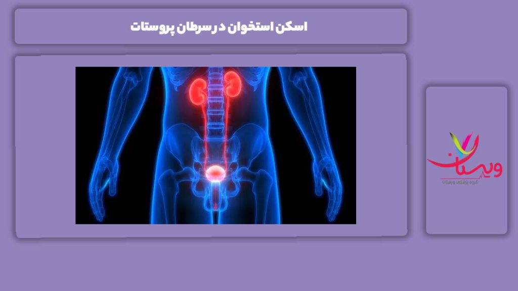 کاربرد اسکن استخوان برای سرطان پروستات اسکن استخوان در سرطان پروستات