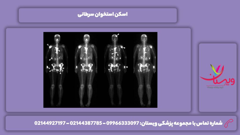 اسکن هسته ای استخوان