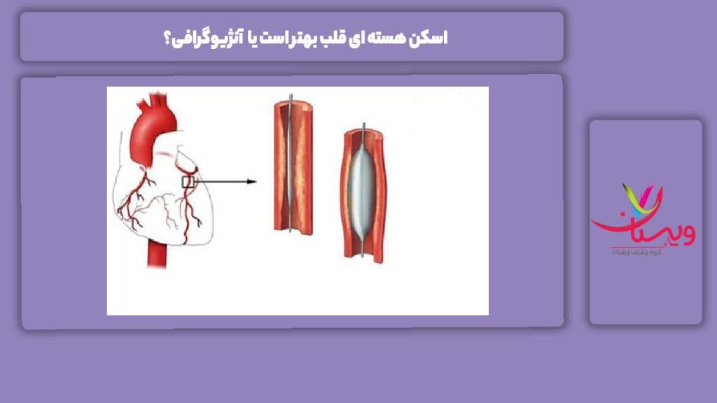 اسکن هسته ای قلب بهتر است یا آنژیوگرافی؟