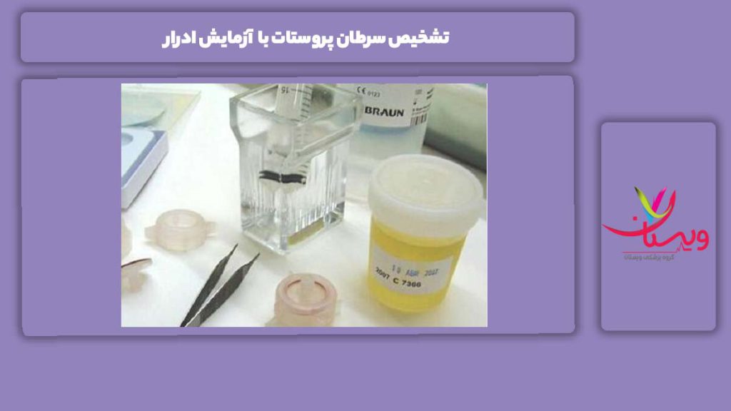 ویژگی شناسایی سرطان پروستات با آزمایش ادرار تشخیص سرطان پروستات با آزمایش ادرار