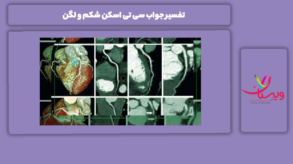 تفسیر جواب سی تی اسکن شکم به همراه لگن تفسیر جواب سی تی اسکن شکم و لگن