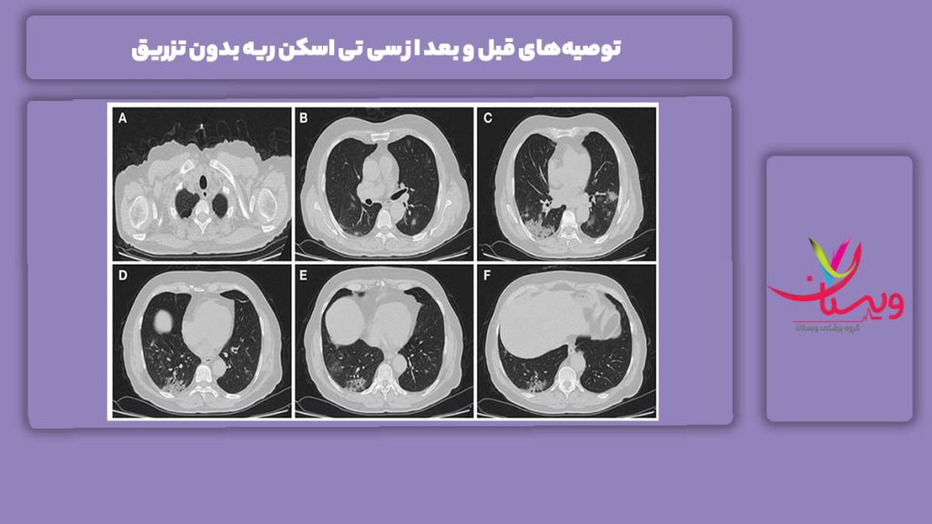 توصیه‌های قبل و بعد از سی تی اسکن ریه بدون تزریق
