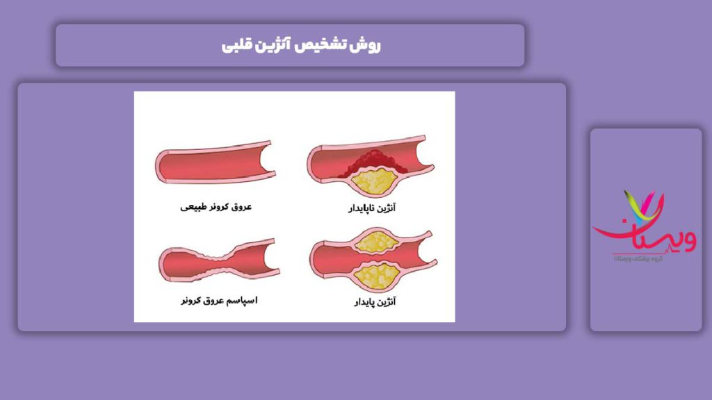 روش تشخیص آنژین قلبی