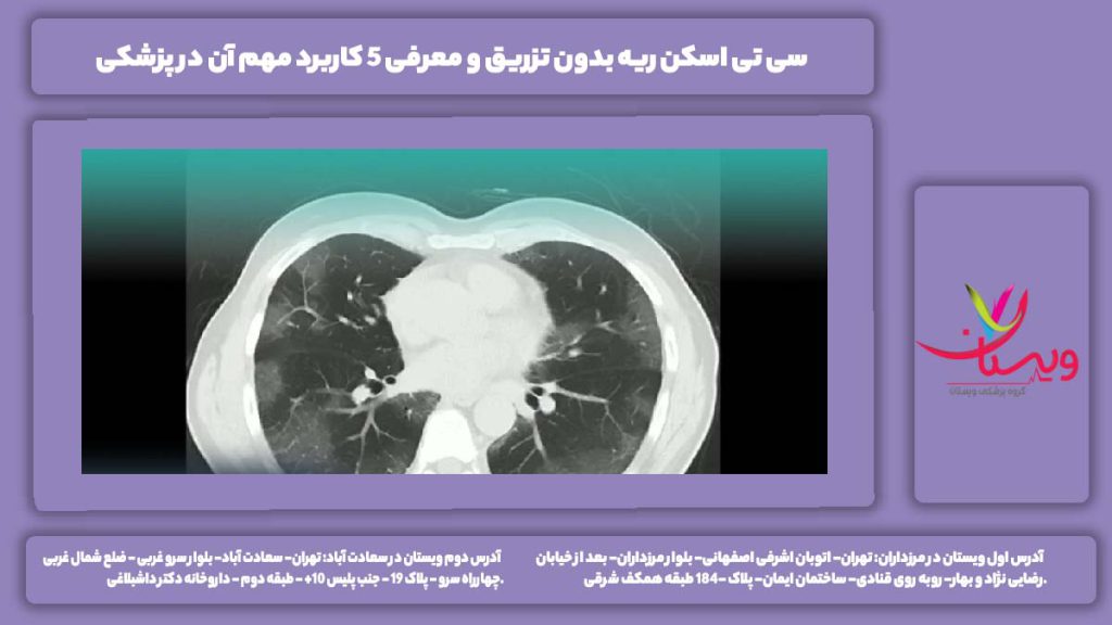 سی تی اسکن ریه بدون تزریق