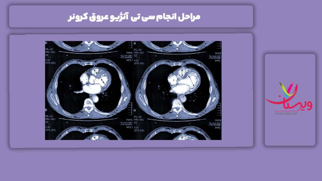 مرحلههای سی تی آنژیو عروق کرونر مراحل انجام سی تی آنژیو عروق کرونر