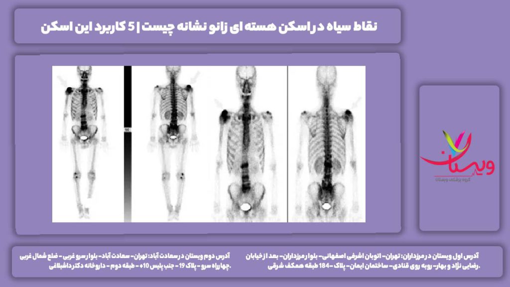 اسکن هسته ای زانو
