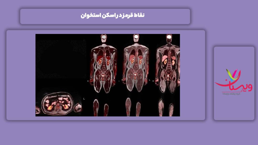 نقاط قرمز در اسکن استخوان