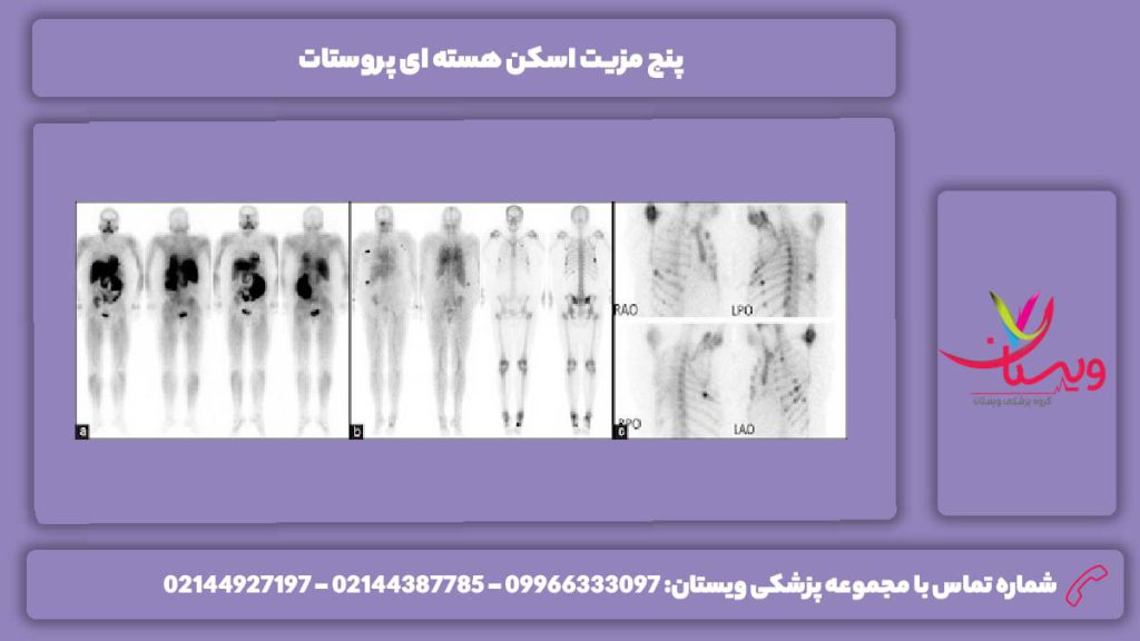 خوبیت اسکن پروستات ۵ مزیت اسکن هسته ای پروستات