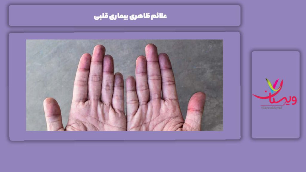 علائم ظاهری بیماری قلبی