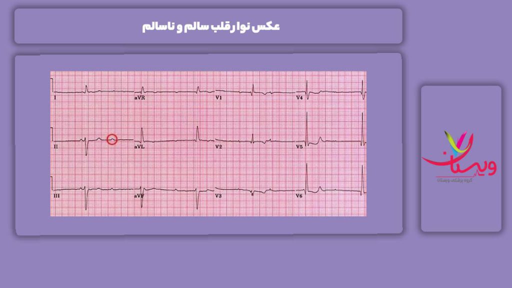عکس نوار قلب سالم و ناسالم