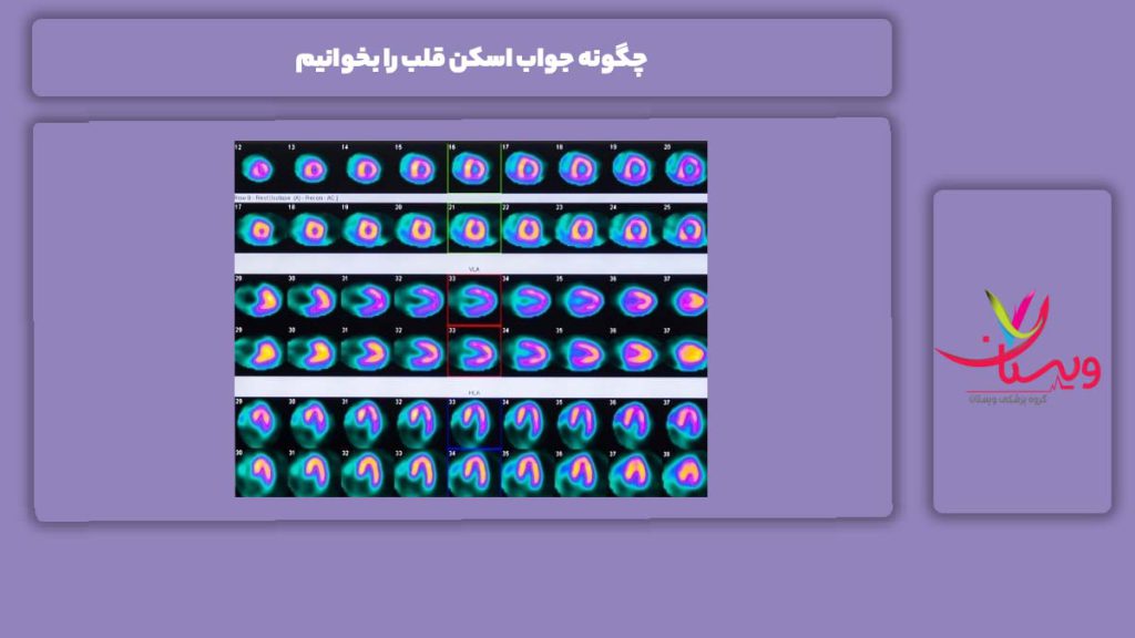چگونه جواب اسکن قلب را بخوانیم