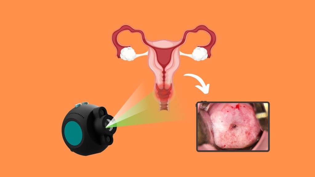 هزینه کولپوسکوپی در مطب + 5 هزینه کولپوسکوپی در تهران