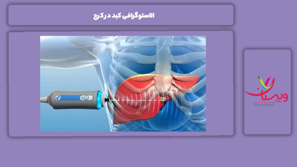 الاستوگرافی کبد در کرج