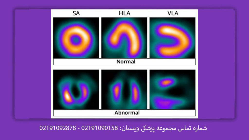 تحلیل نتیجه اسکن قلب