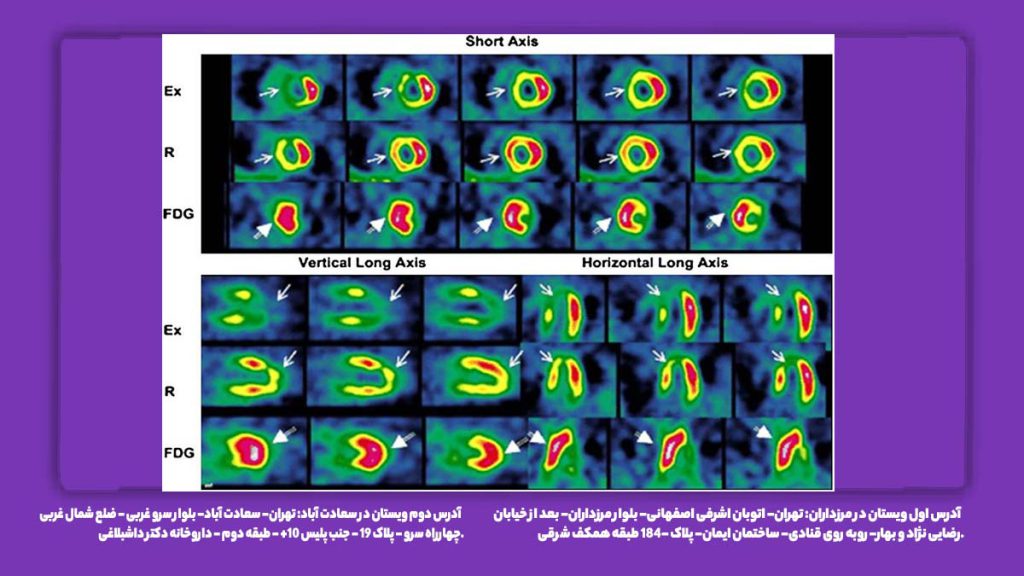 جواب اسکن هسته ای قلب نرمال