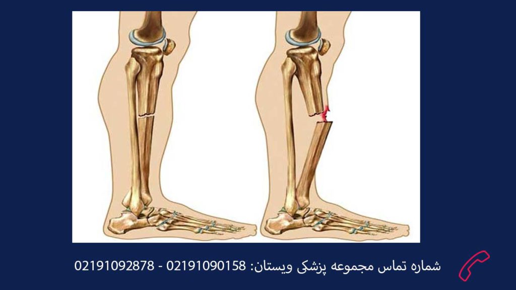 نشانههای کاهش تراکم استخوان علائم پوکی استخوان پا