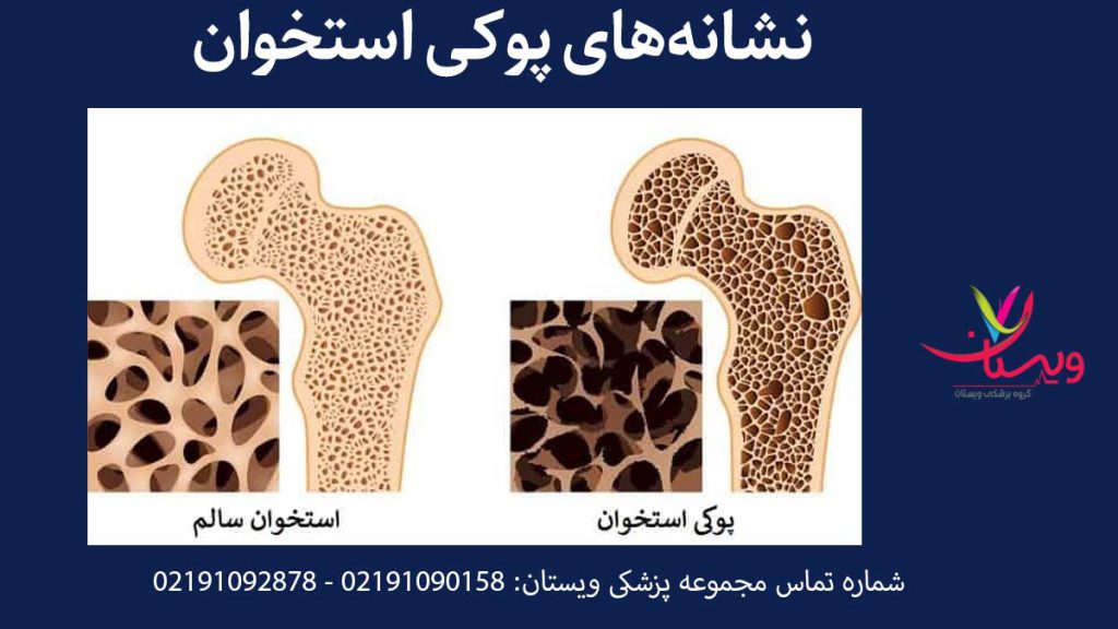 علائم تراکم استخوان چیست