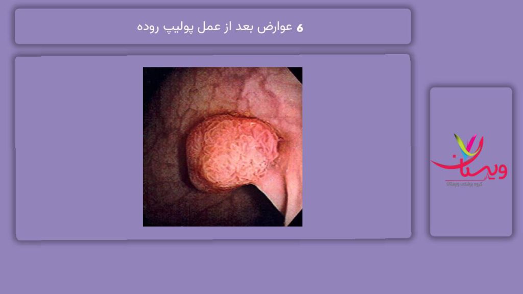 پیامدهای بعد از عمل 6 عوارض بعد از عمل پولیپ روده
