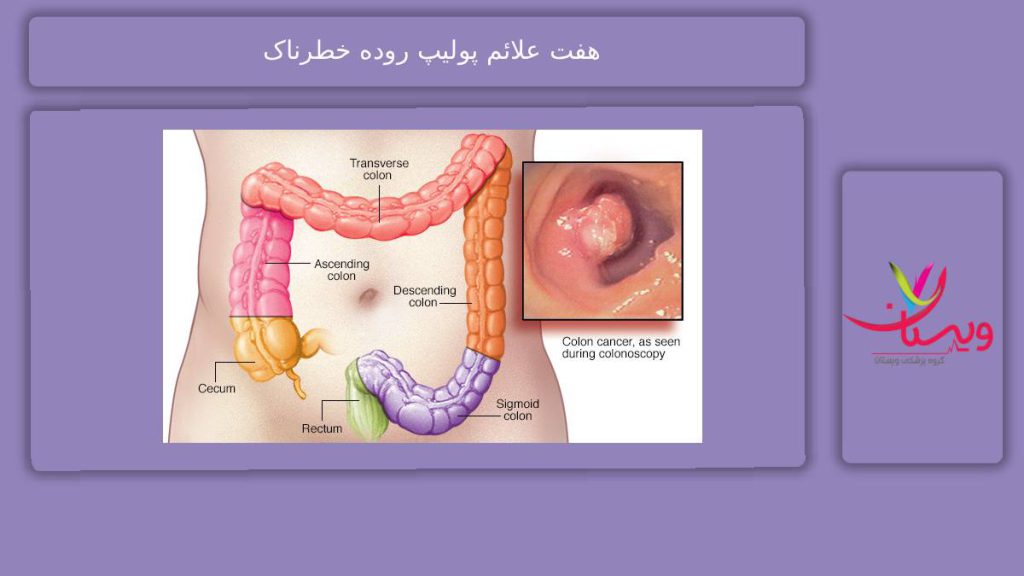 نشانههای مهم پولیپ خطرناک 7 علائم پولیپ روده خطرناک