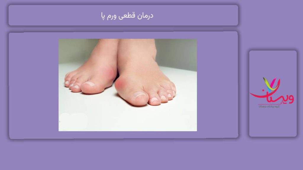 درمان قطعی ورم پا
